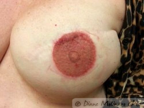 Areola enhancement After Left