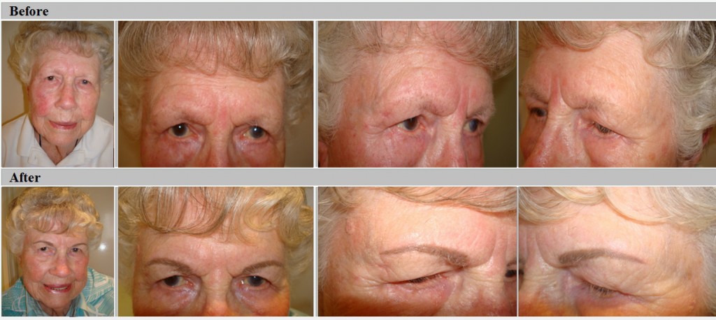Softstroke Eyebrows Before and After
