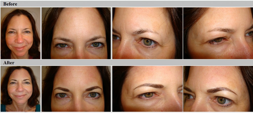 Hairstroke Eyebrows Before and After
