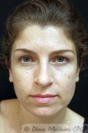 After Acne Microneedling