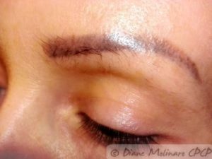 Before brow removal, left