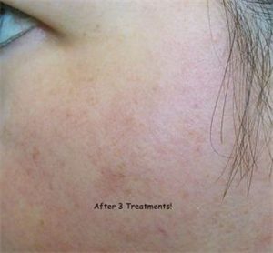 after 3 treatments microneedling