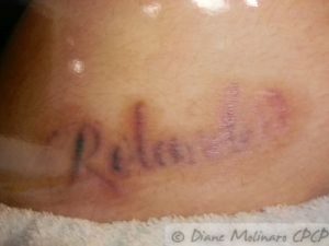 tatoo removal Healed After second session