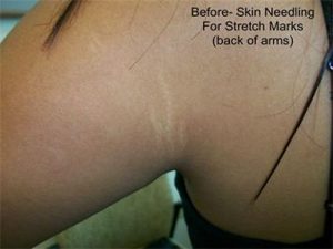 stretch mark Before skin needling