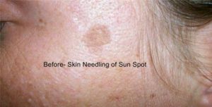 Before Treatment of Sun Spot