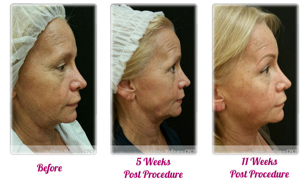 Micro Needling – Full Face - Right View